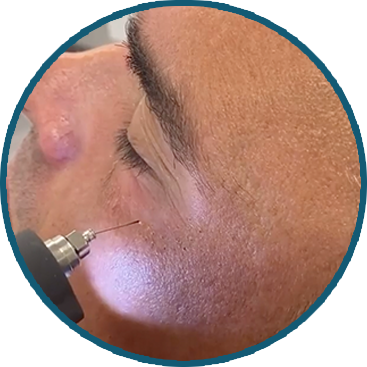 closeup of face with injectable device